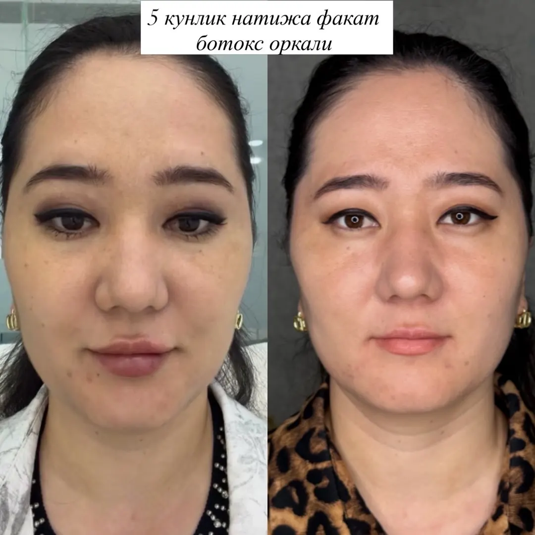 Full Face Botox: chapda — protseduradan oldin, o‘ngda — 5 kundan keyin