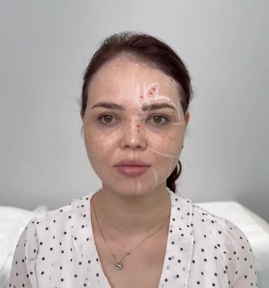 Protsedura oldidan yuzdagi individual razmetka